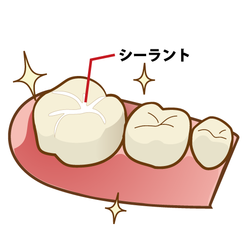 シーラントで虫歯リスクから奥歯を守る