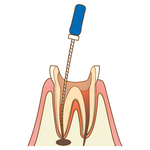 神経の治療「根管治療」