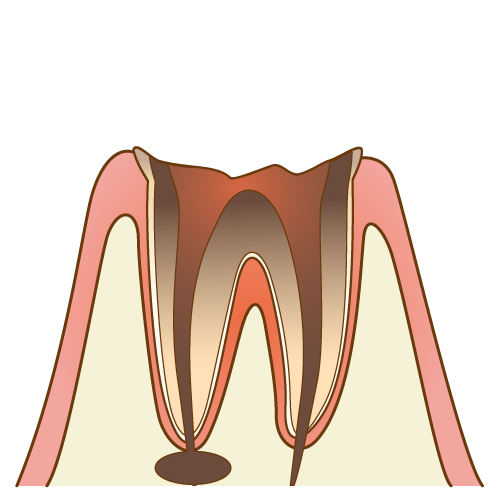 末期の虫歯