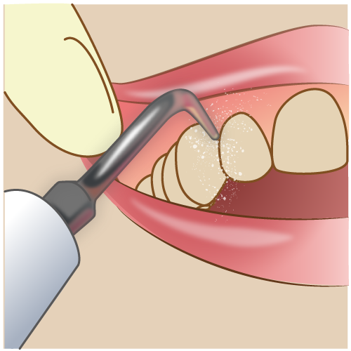 歯石・歯垢の除去