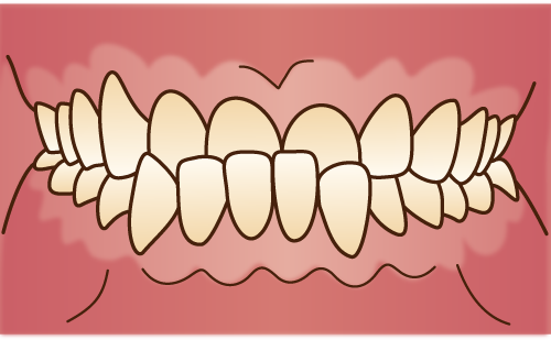 下顎前突（受け口）
