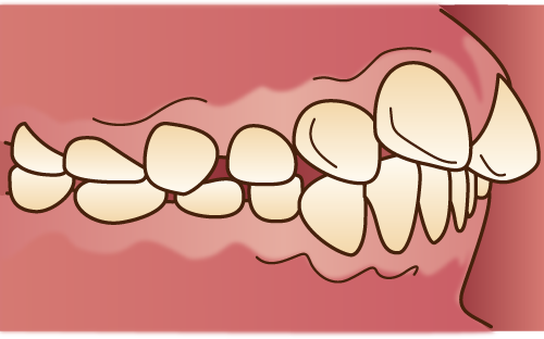 過蓋咬合（ディープバイト）