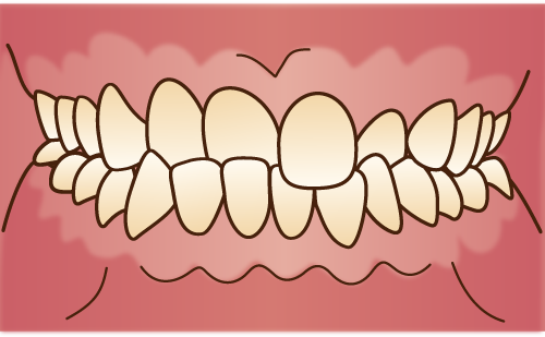 交叉咬合（クロスバイト）