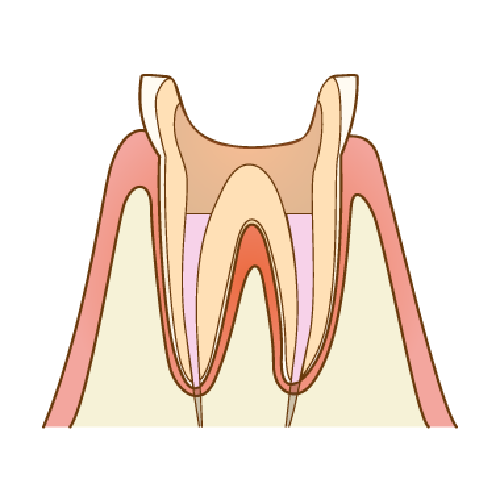 根管治療（歯の根の治療）