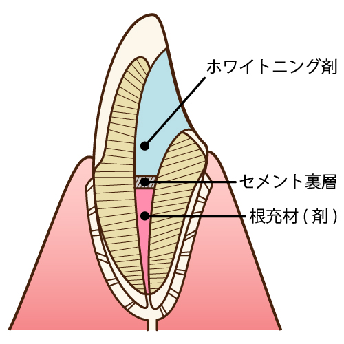 ウォーキングブリーチ