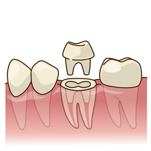 根管治療（歯の根の治療）