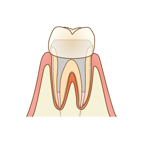 根管治療（歯の根の治療）